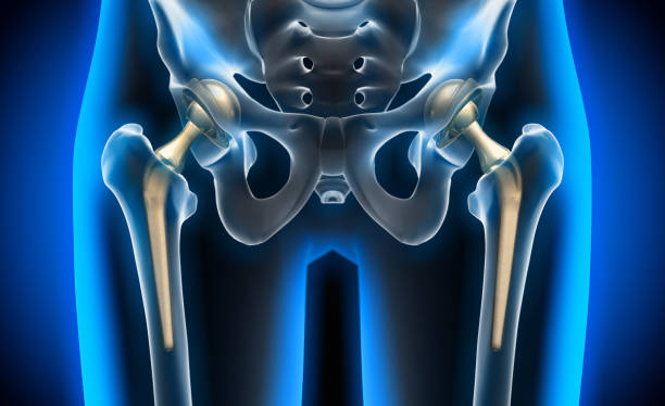 Hip Replacement Market Size, Global Forecast 2028