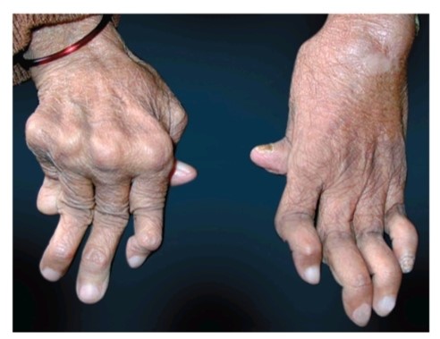 Exploring 5 Homeopathic Remedies for Rheumatoid Arthritis