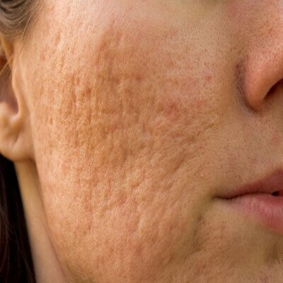 Confidence Redefined: How Scar Removal in Dubai Is Changing Lives!