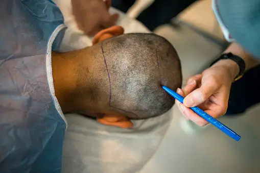 Unlocking Confidence: Afro-Caribbean Hair Transplant in the UK