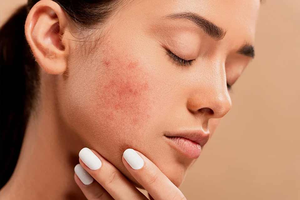 Dubai’s Skin Reset: Laser Scar Removal Explored