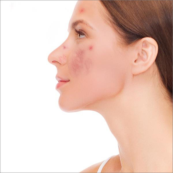 “Say Goodbye to Redness: Facial Capillaries Treatment Unveiled”