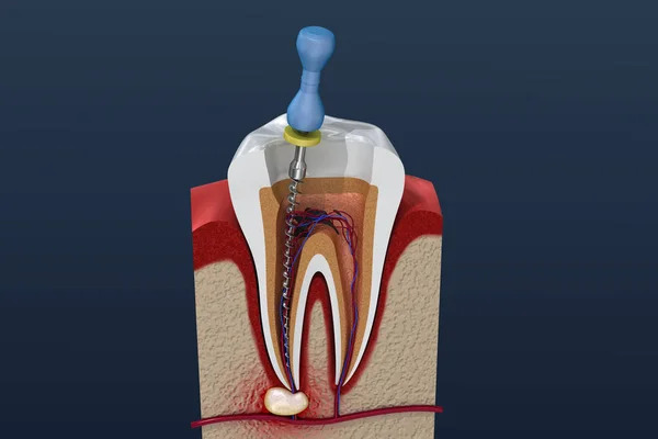 State-of-the-Art Root Canal Therapy in Dubai