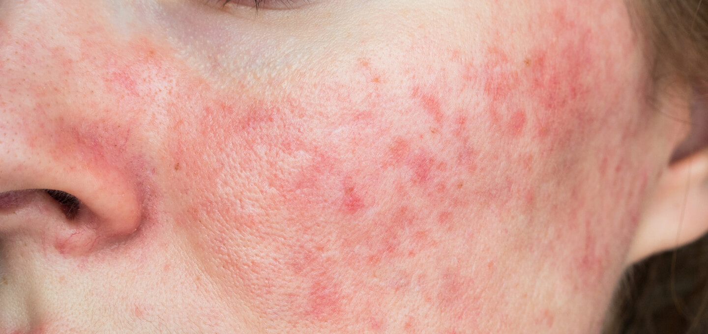 Investigating Natural Remedies for Rosacea Relief