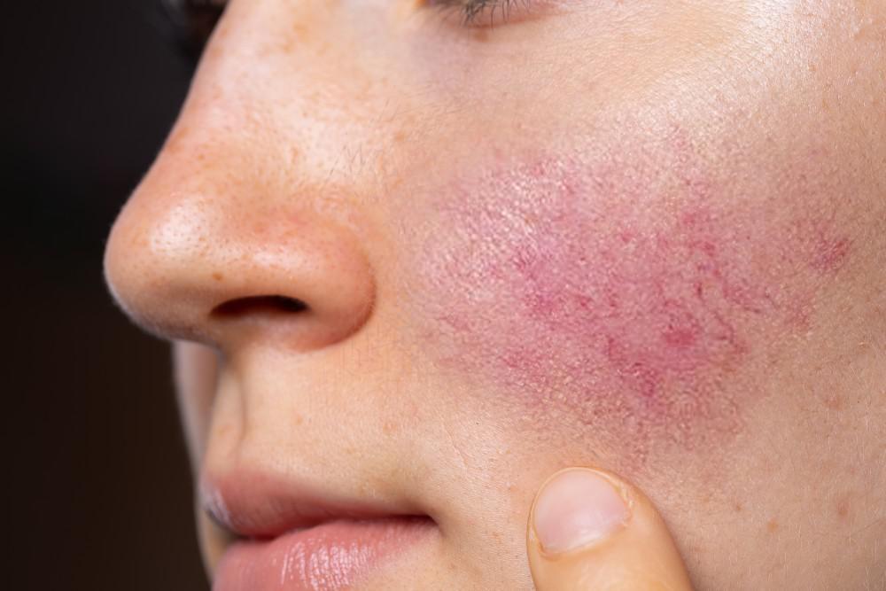 Dubai’s Secret to Rosacea-Free Skin Revealed