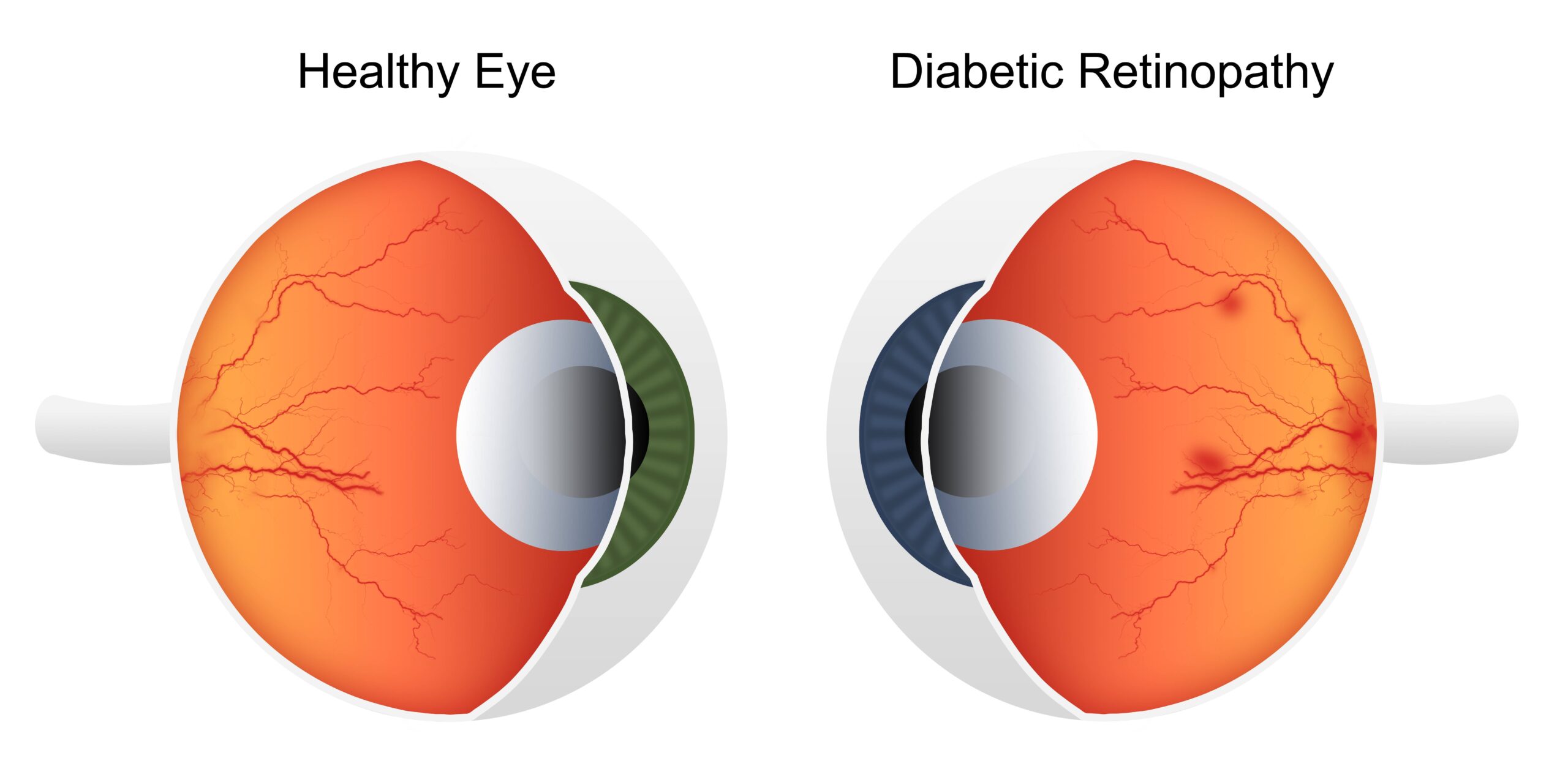 Diabetic Retinopathy Market Trends & Forecast by 2033 | FMI