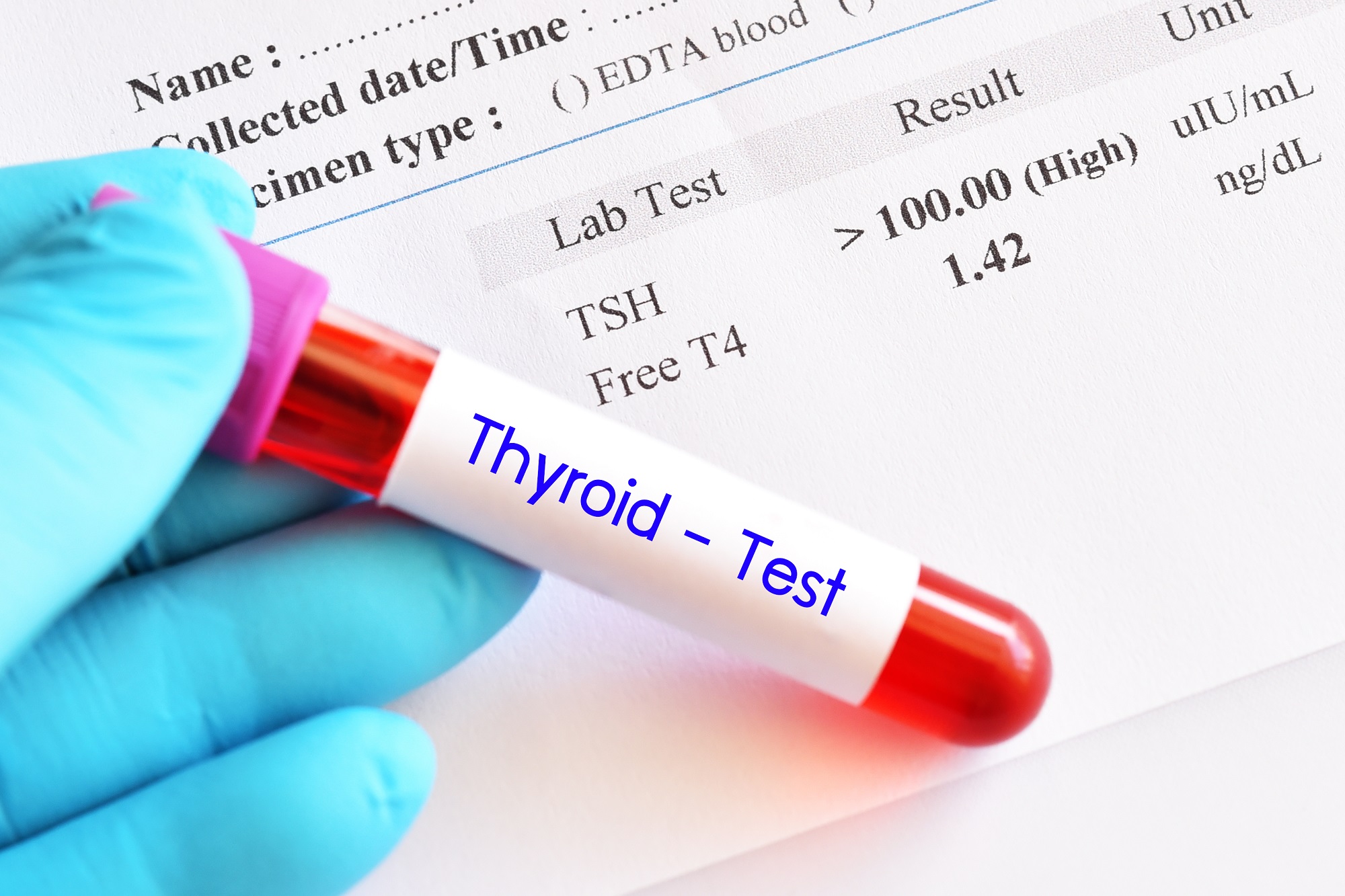 Thyroid Function Tests Market Size, Share & Forecast by 2033